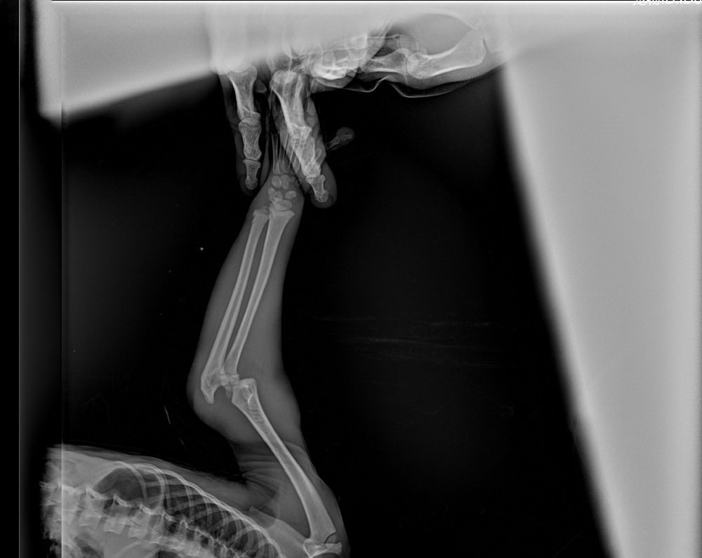 山魈骨折后的紧急治疗